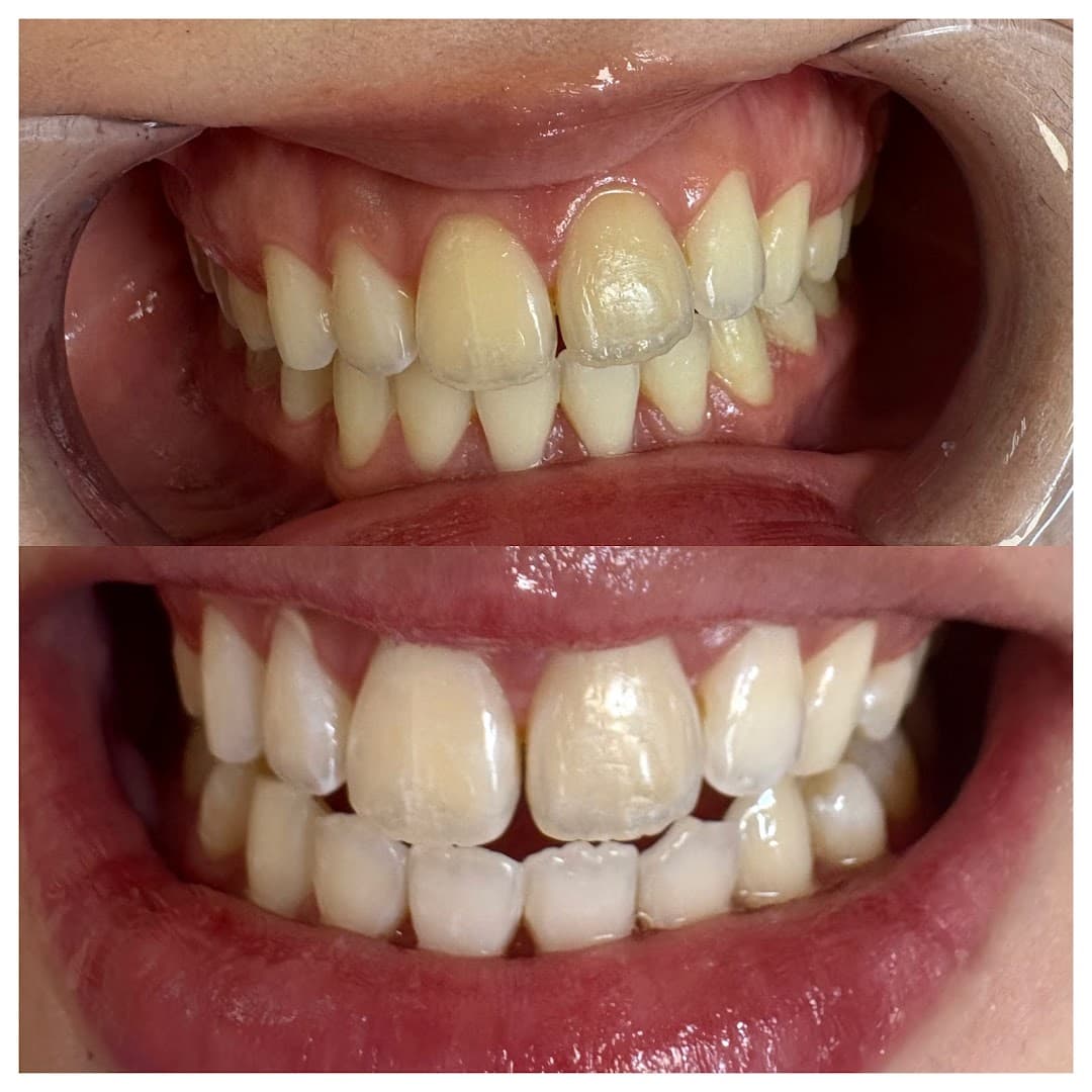 Teeth Whitening Valencia | OSmile | Professional & Affordable Laser Whitening • Valencia